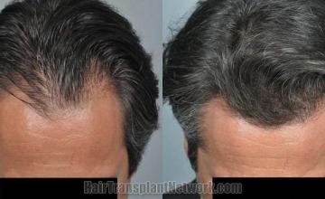 Top view before and after hair restoration results