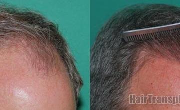 Right view before and after hair replacement procedure