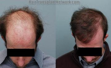 Top view before and after hair restoration procedure