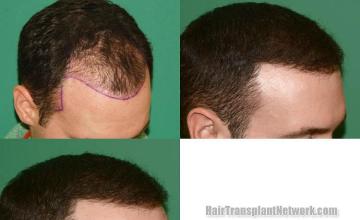 Hair restoration procedure before and after result images