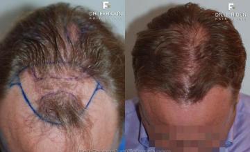 Top view before and after hair restoration