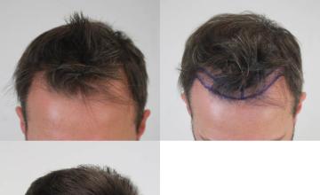 Top view - Before and after hair restoration procedure