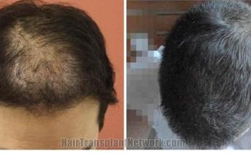 Hair restoration procedure before and after results