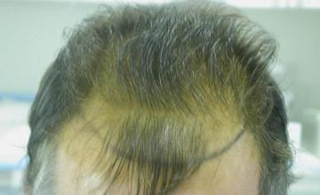 Hair transplantation surgery before and after photos