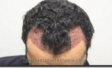 Hair restoration procedure results