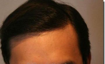 Hair restoration procedure results