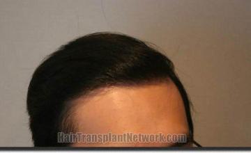 Hair restoration procedure results