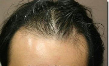 Hair restoration procedure results