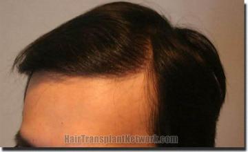 Hair restoration procedure results