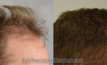 Hair transplantation surgery before and after images