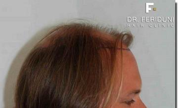 Hair restoration procedure results