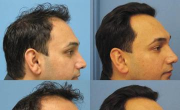 Hair transplant before and after photos