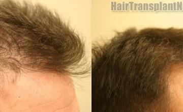 Hair transplantation surgery before and after images