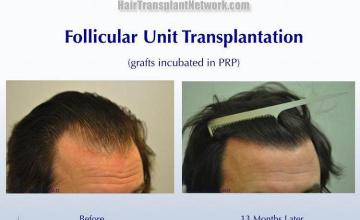 Hair transplantation surgery before and after images