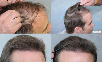 Hair transplantation surgery before and after images