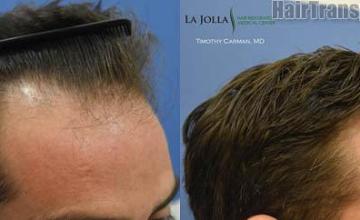 Hair restoration procedure before and after results photographs