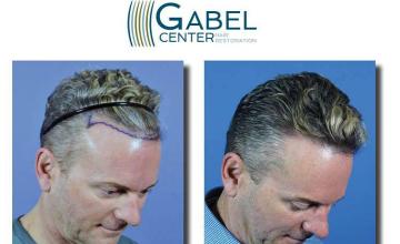 Hair transplantation surgery before and after images