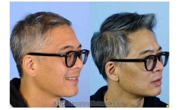 Hair transplantation surgery before and after images