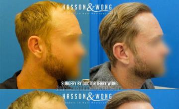 Hair restoration procedure before and after result images