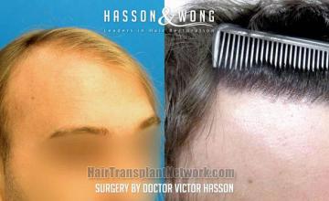 Hair restoration procedure before and after result images