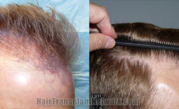 Hair transplantation surgery before and after images