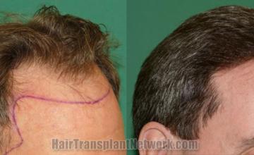 Hair transplantation surgery before and after images