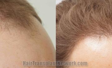 Hair transplantation surgery before and after images