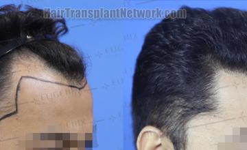 Hair transplantation surgery before and after images