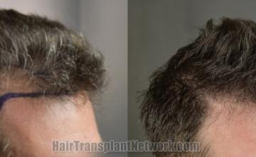 Hair transplantation surgery before and after images