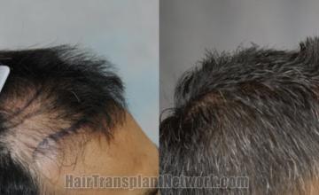 Hair transplantation surgery before and after images