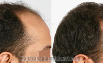 Hair transplantation surgery before and after images