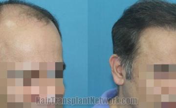 Hair transplantation surgery before and after images