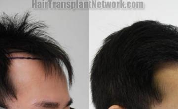 Hair restoration procedure before and after result images