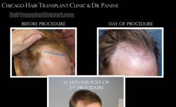 Hair transplantation procedure before and after results