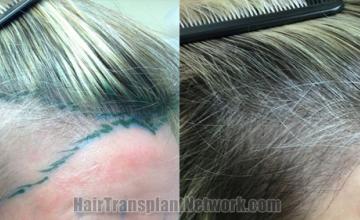 Hair transplantation surgery before and after images