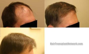 Hair restoration procedure before and after results