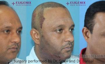 Hair transplantation procedure before and after results