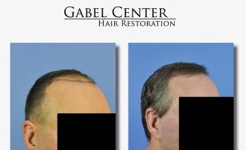 Hair transplantation surgery before and after pictures