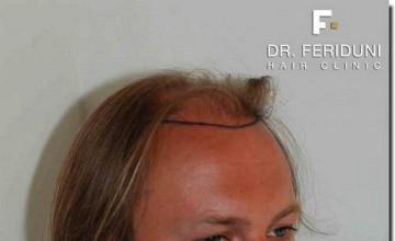 Hair restoration procedure results