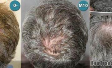 Crown / Back photos showing hair restoration results