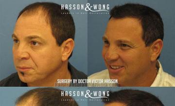 Hair transplantation surgery before and after images