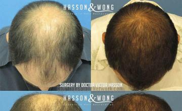 Before and after hair transplantation result photographs