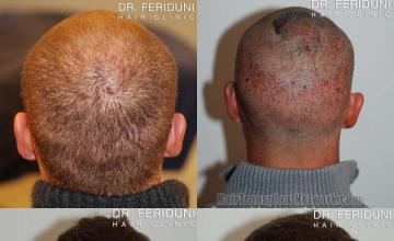 Hair transplantation surgery before and after photos