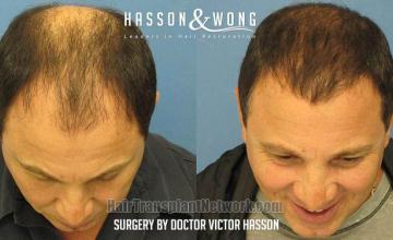 Before and after hair restoration procedure images