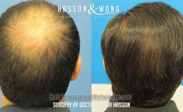 Hair transplant surgery before and after photos