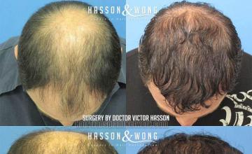 Hair restoration procedure before and after pictures