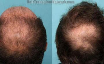 Crown / Back view of hair transplant surgical procedure