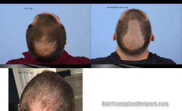 Hair transplantation surgery before and after images