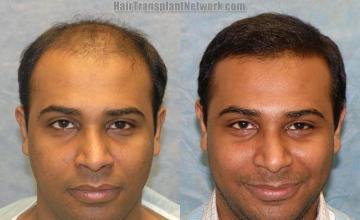  before and after photos 