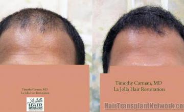 Hair restoration procedure before and after results